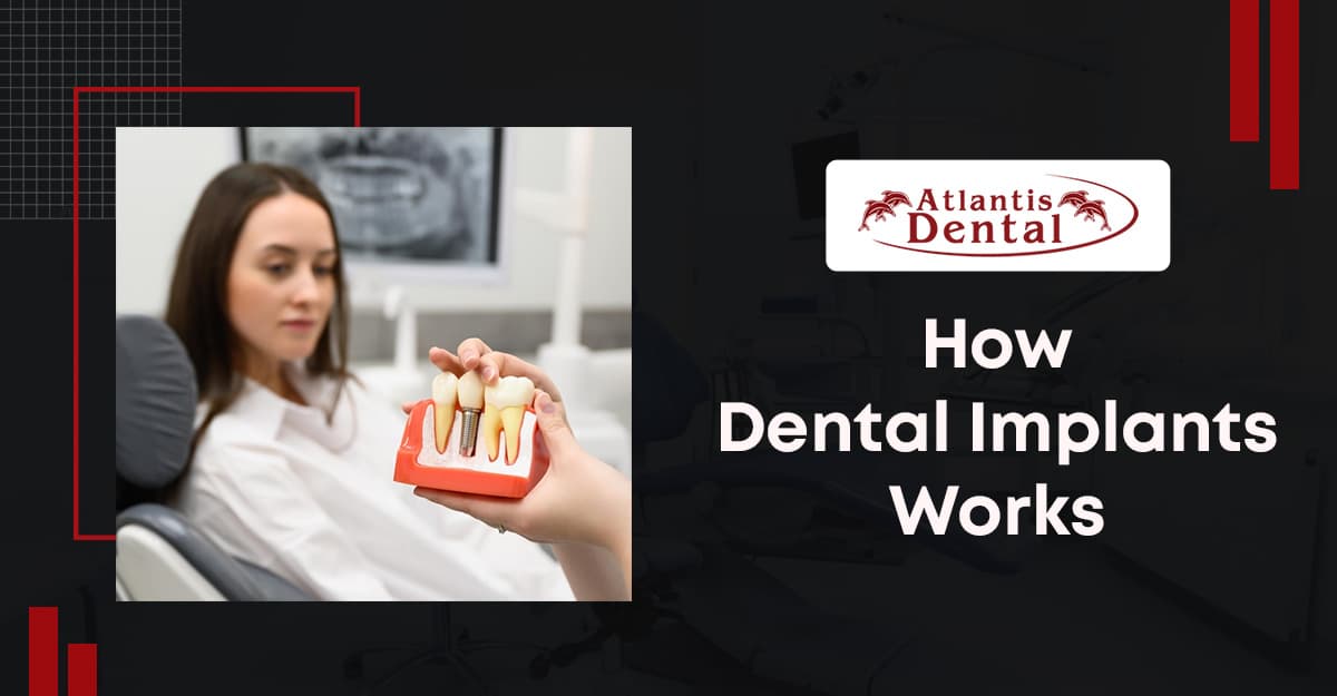 How Dental Implants Works