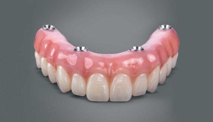 Dental Implant Denture
