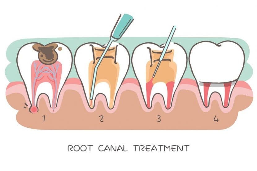 Do you shiver at the thought of root canal therapy? Here's why you shouldn't.