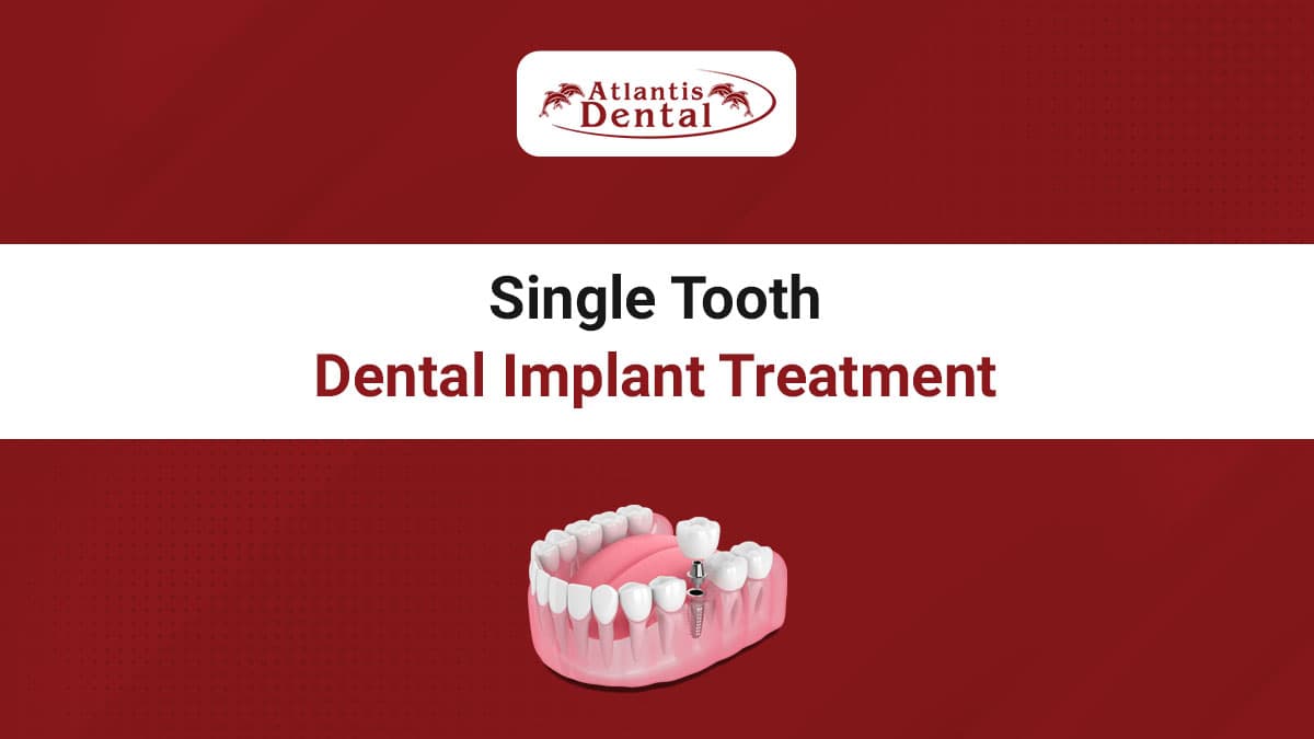 Single tooth Dental Implant treatment