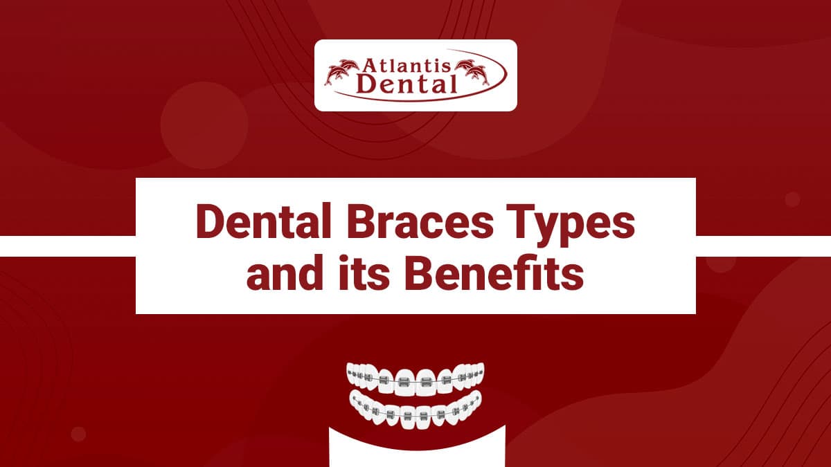 Types of Dental Braces | Atlantis Dental