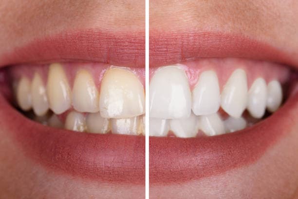 Why Teeth Whitening is Best Done at the Dentist